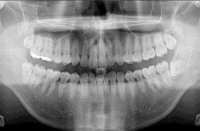 パノラマレントゲン検査