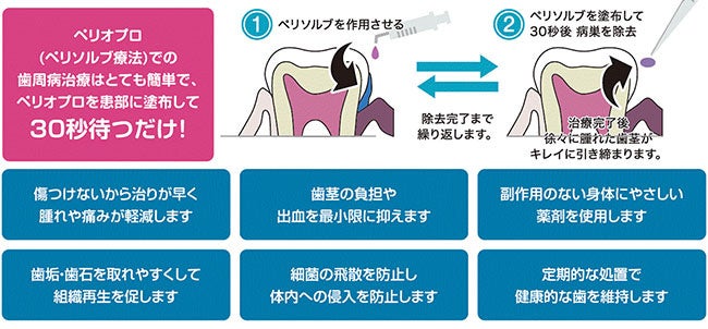 ペリオプロ(ペリソルブ療法)