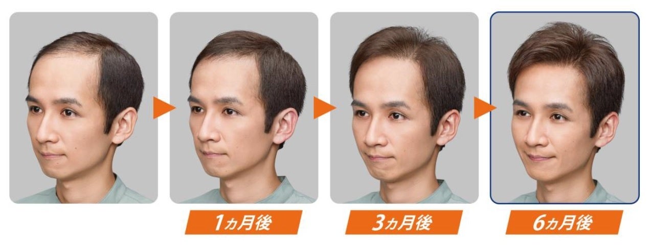 ※段階増毛イメージ例