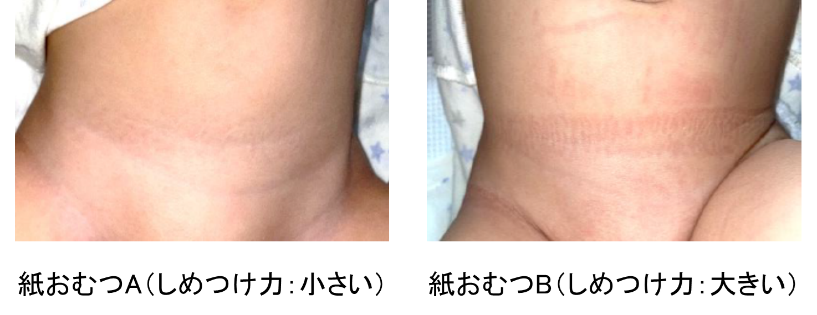 図1　紙おむつの腹部へのしめつけによるゴム跡の違い（顕著な例）