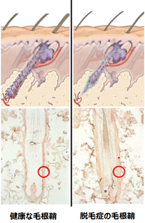 図１：健康な毛包（左）と 脱毛症の毛包（右）