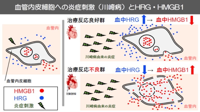 岡山大学】新規バイオマーカーを用いて難治性川崎病の病態を解明