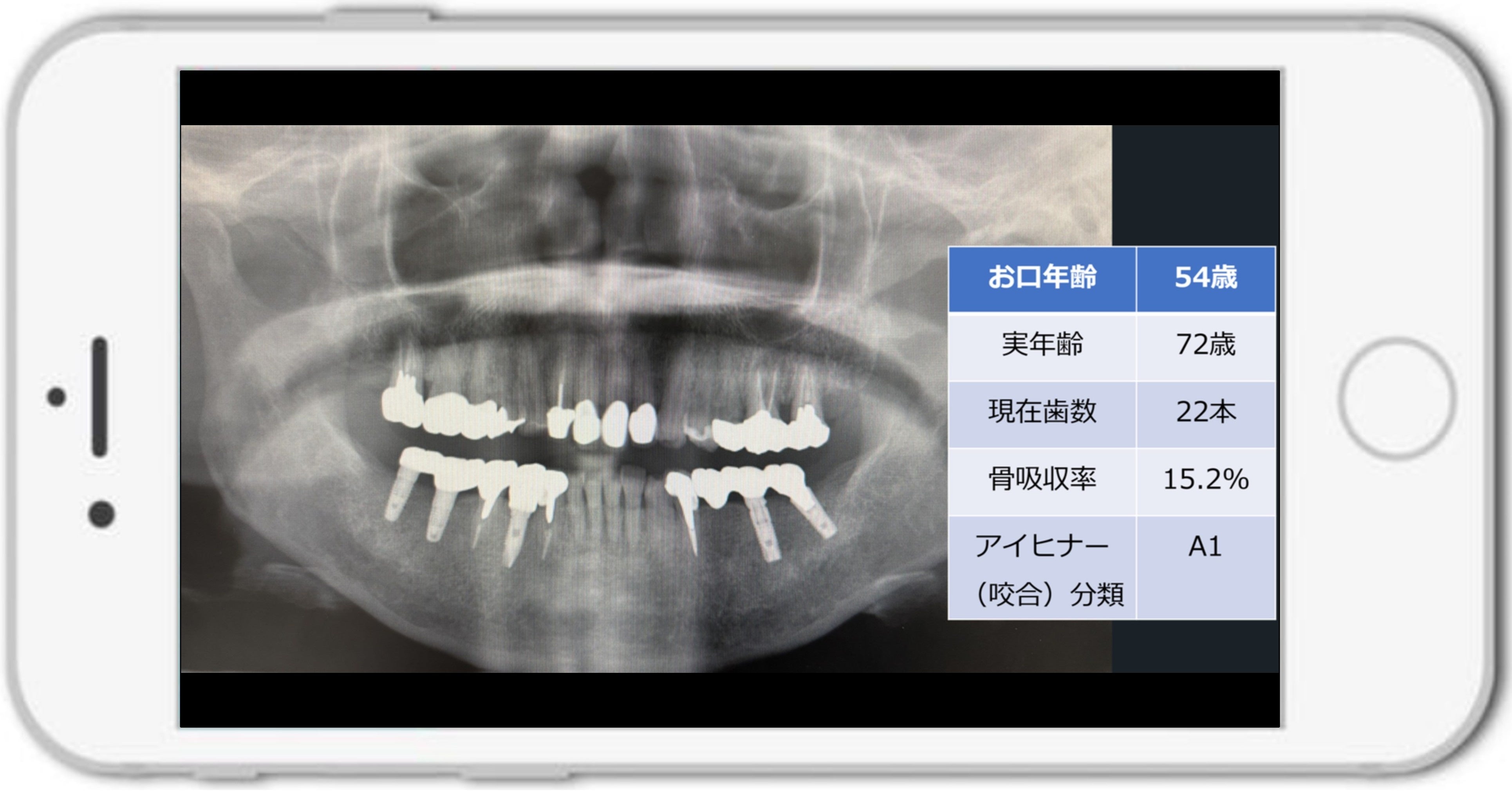 歯科エックス線画像を用いた「お口年齢AI」の開発について | 医療法人