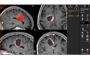 Brainlab® ElementsにAI技術を新たに搭載