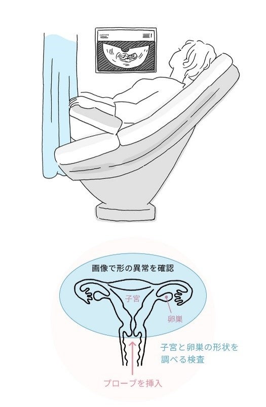 経腟超音波検査