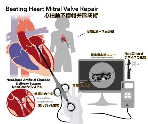 人工心肺を用いない「僧帽弁形成術」が都内で初めて成功 | 医療法人 人工心肺を用いない「僧帽弁形成術」が都内で初めて成功 | 医療法人