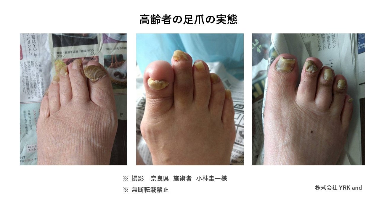 フットケア　早い者勝ち！！ 調剤薬局×フットケアで地域貢献へ！「ASHIst（アシスト）」マッチング