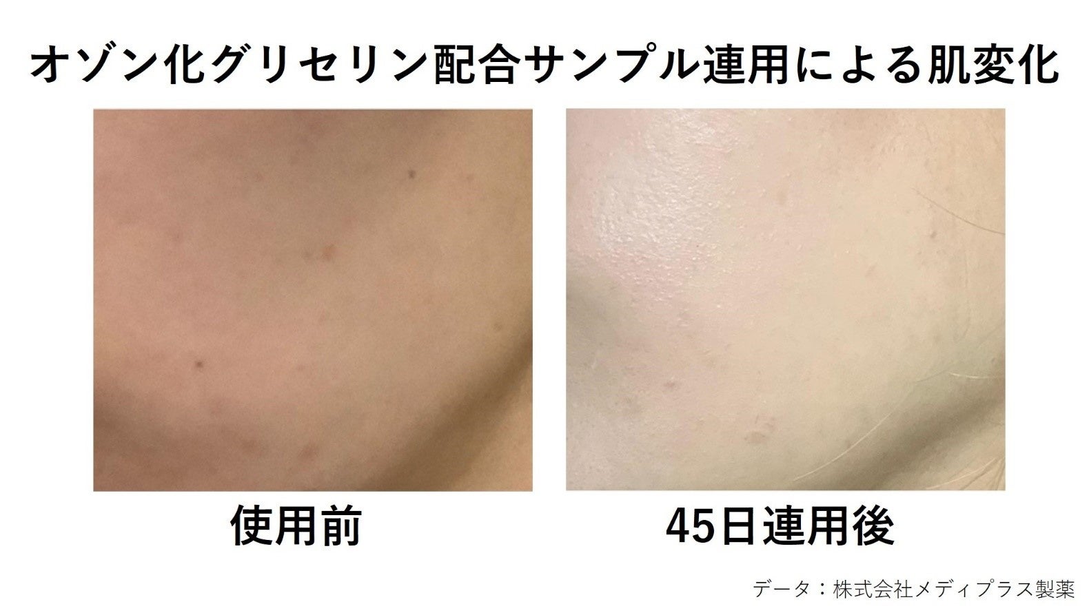 8週間の継続使用で92 の人に効果あり 今あるシミへの新たな可能性 株式会社メディプラス製薬のプレスリリース 8週間の継続使用で92 の人に効果あり 今あるシミへの新たな可能性 株式会社メディプラス製薬のプレスリリース