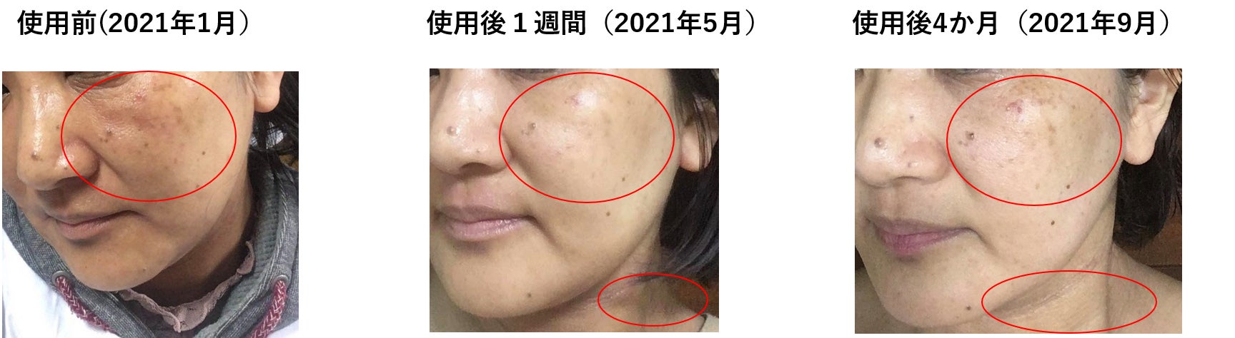 超敏感肌でも使える美白ケア 独自成分 オゾン化グリセリン アトピー既往歴にも安全に使えることを確認 株式会社メディプラス製薬のプレスリリース 超敏感肌でも使える美白ケア 独自成分 オゾン化グリセリン アトピー既往歴にも安全に使えることを確認 株式会社メディプラス製薬のプレスリリース