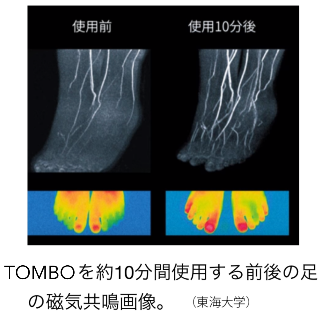 Tombo をわずか10分使用した後の足のMRIのビフォーアフター