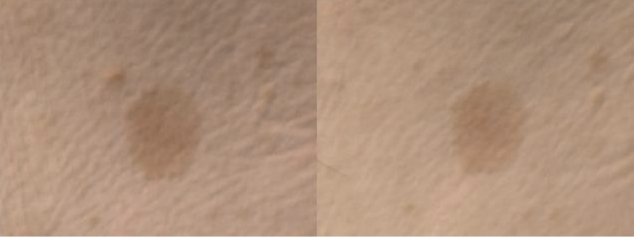 【シミ】左：before、右：after