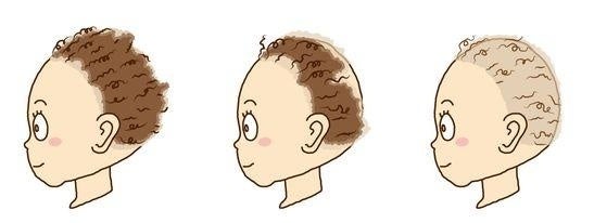 先天性乏毛症・縮毛症：生まれつき縮れ毛で伸びる過程で切れてしまう髪の毛。幼少期は性別を間違えられる、地毛で過ごすことが多いため大人になってウィッグを使用し始めるタイミングに悩むなどの特徴があります。