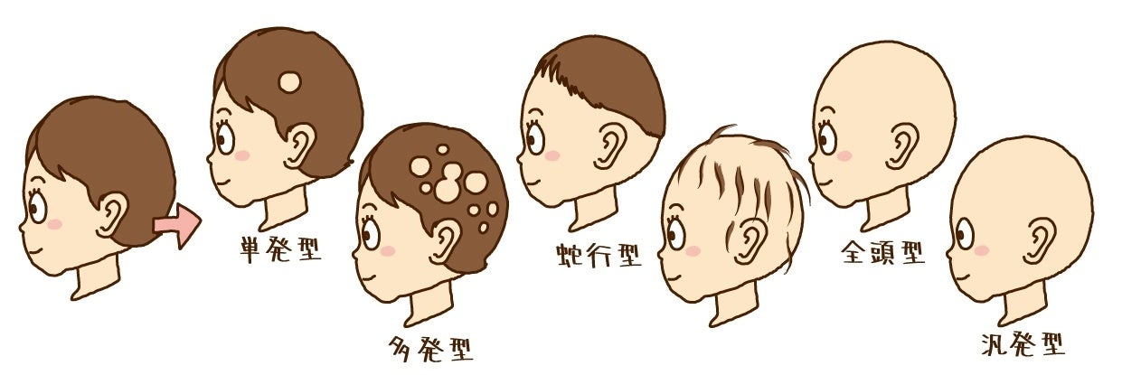 円形脱毛症：繰り返し抜ける事や、進行の途中の状態が当事者には一番つらい状態です。