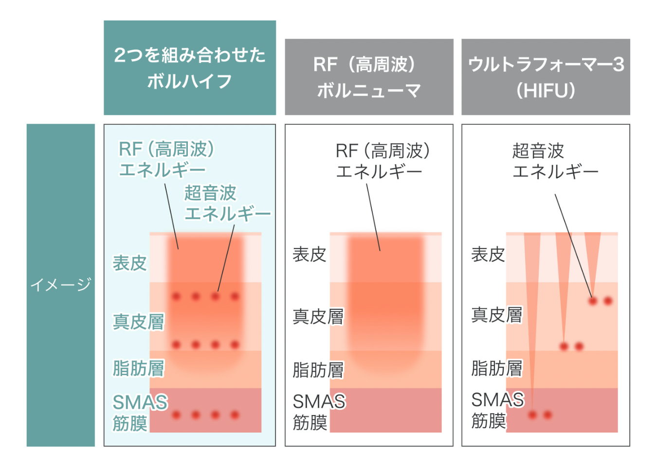 RF 高周波 業務用美顔器　ウルトラチューン　バイタリフト　たるみ　しわ　ハイフ RF 高周波 業務用美顔器 ウルトラチューン バイタリフト たるみ しわ