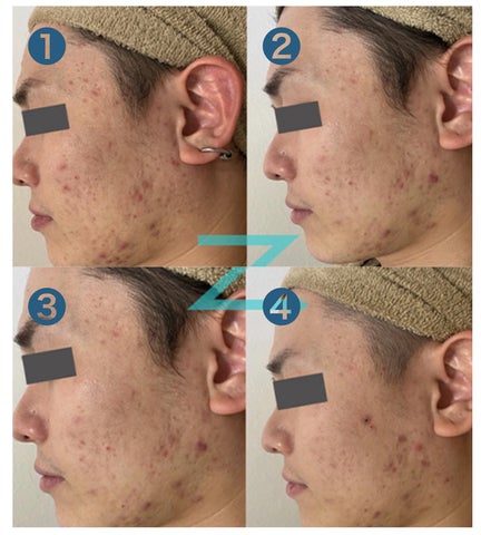 業務用プラズマ美顔器|あらゆる肌悩みを1台で!シミプラズマネオが 業務用プラズマ美顔器|あらゆる肌悩みを1台で!シミプラズマネオが