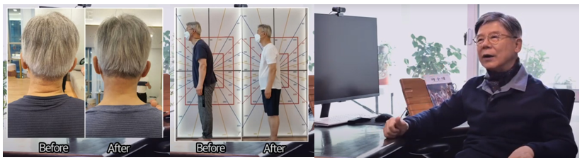 パーキンス病患者のbefore after