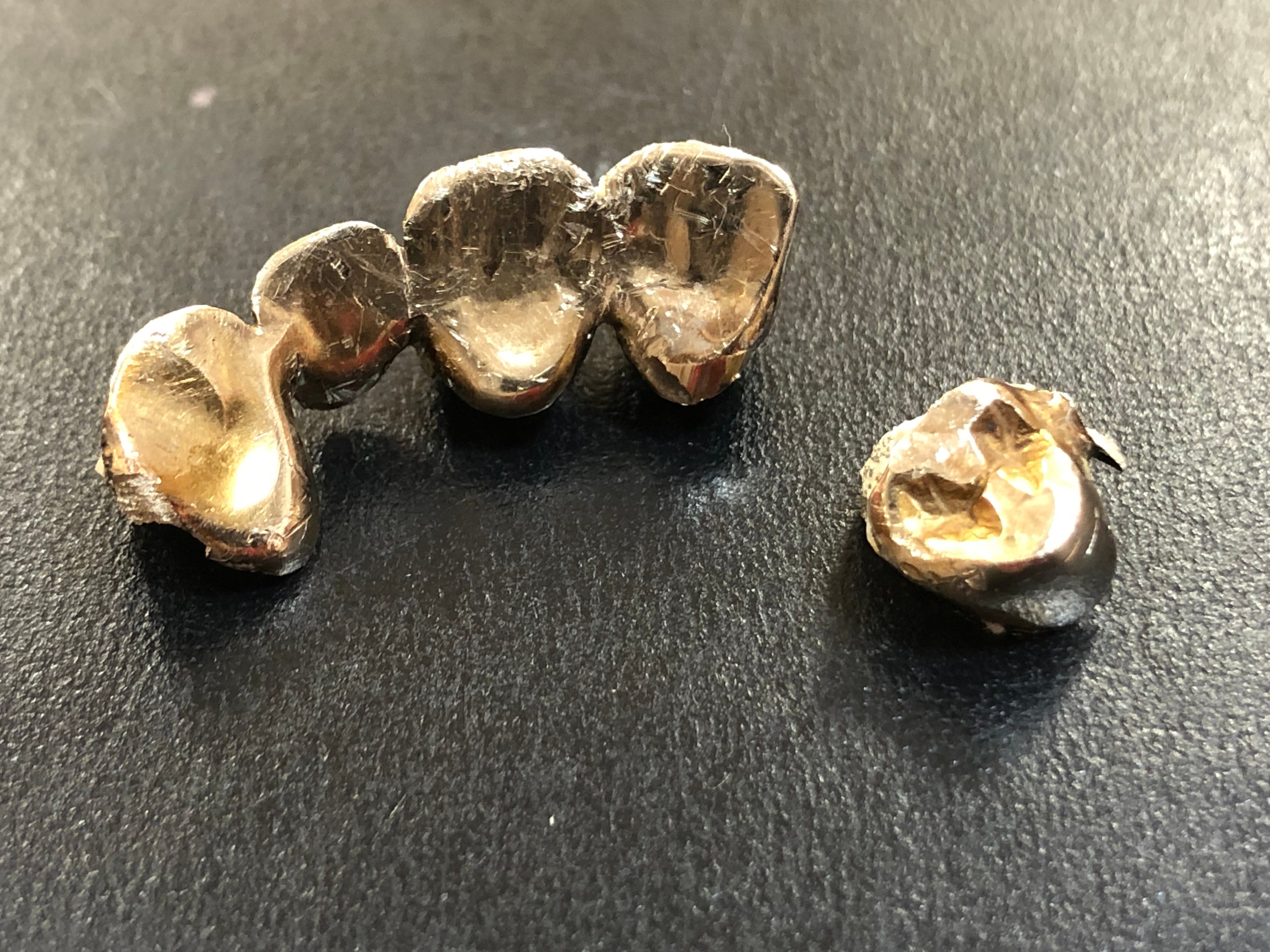 【全国約300店舗を展開するジュエルカフェが調査】捨てる前に待って、その金歯――金属部分5グラムで9万円前後の可能性も