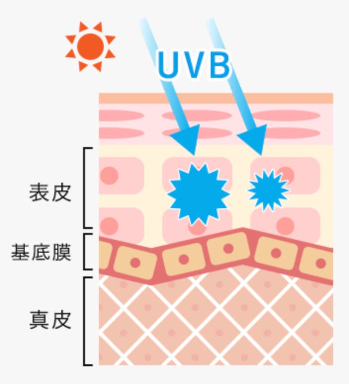 UVBの特徴