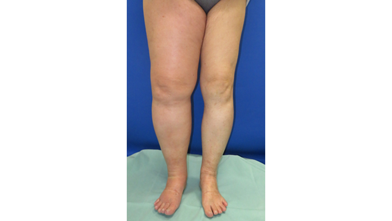 図1：「リンパ浮腫」の症例イメージ