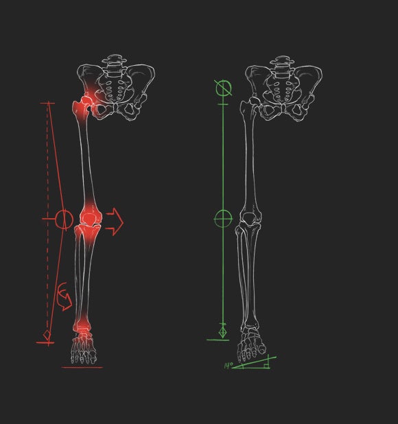 （左）内反ウェッジなし（右）Body Geometry内反ウェッジあり