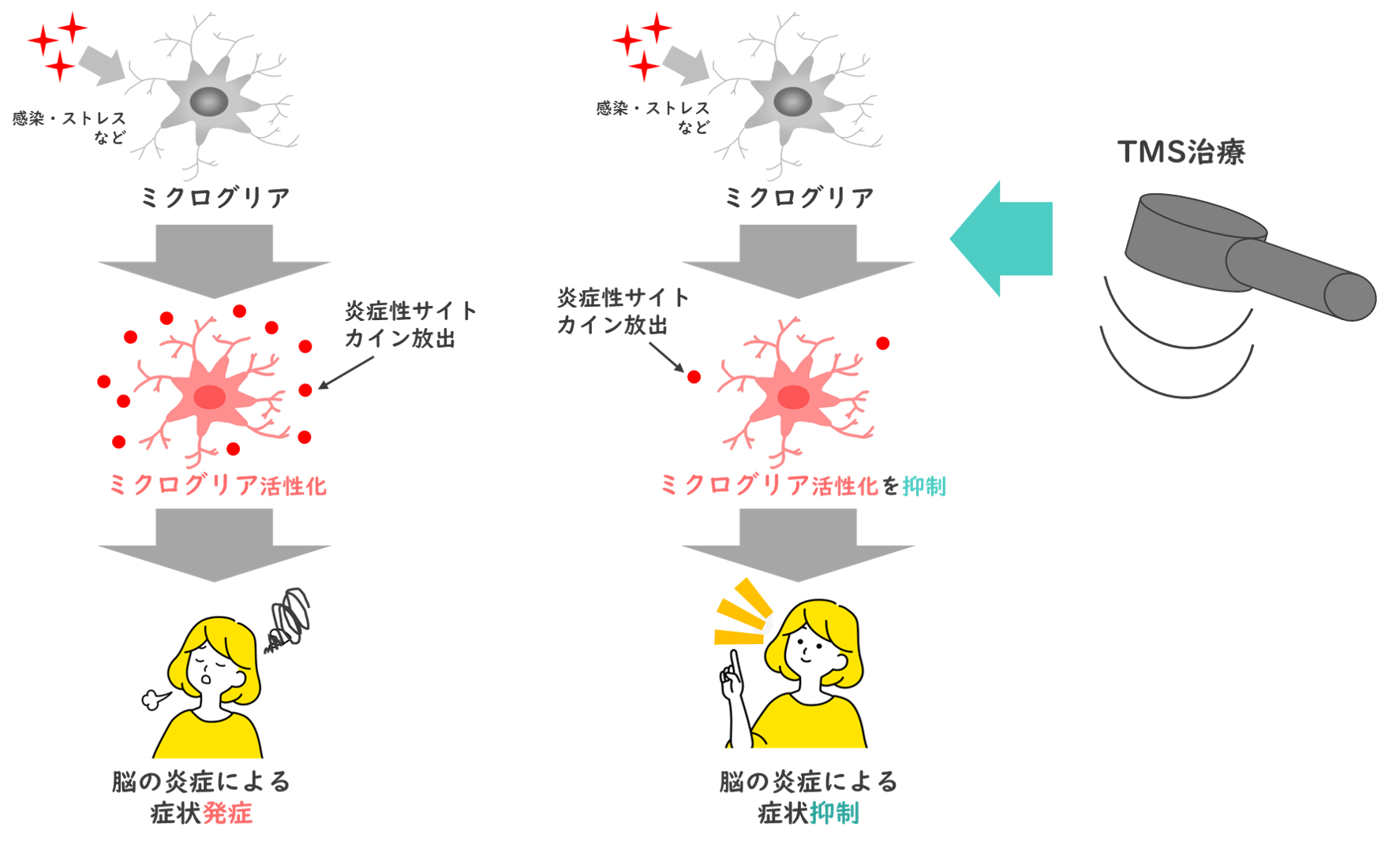 脳の炎症　TMS治療